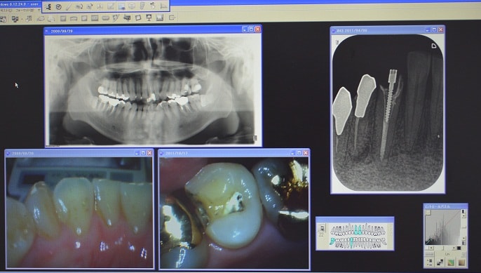 口腔内情報写真